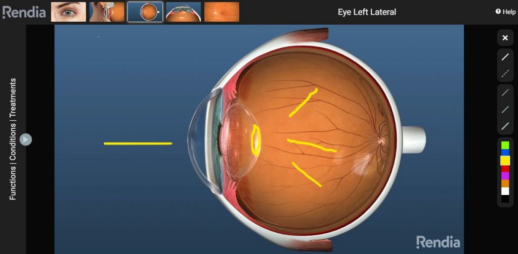 Eye cross section with a sketch showing light scatter from cataract