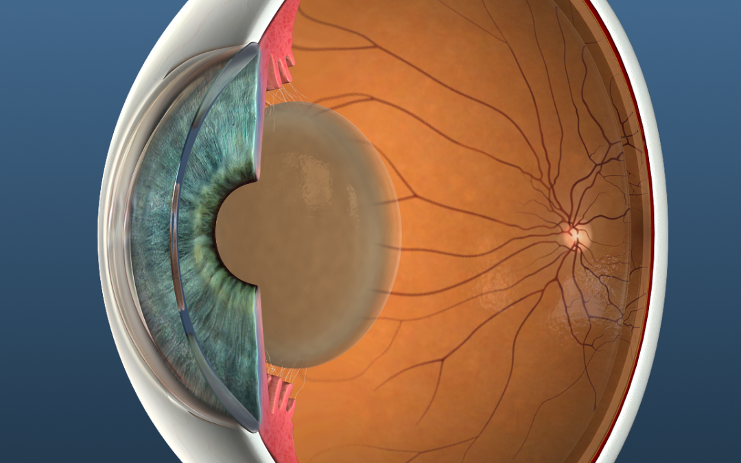 Five Cataract Myths to Clear Up for Your Patients