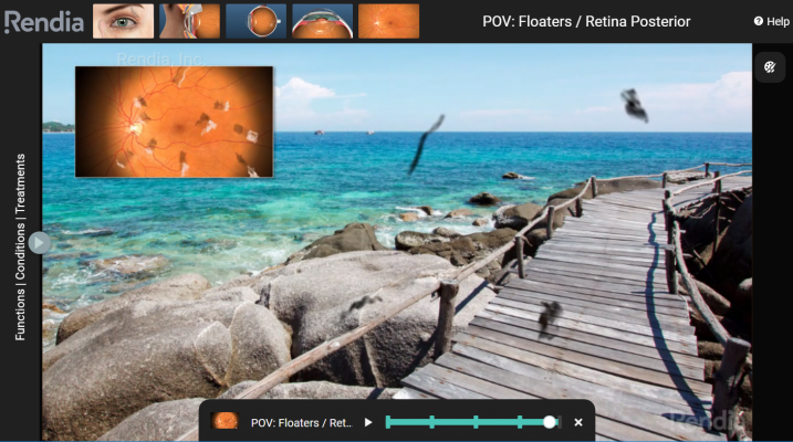 Demonstrate how patients’ eye conditions progress with Point-of-Views