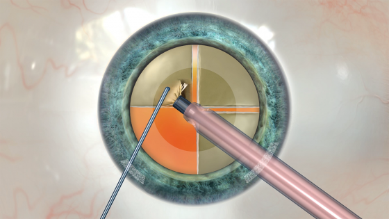 Three Ways to Reach More Cataract Patients