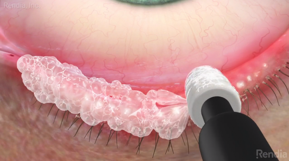 New Treatment Options for Blepharitis Rendia