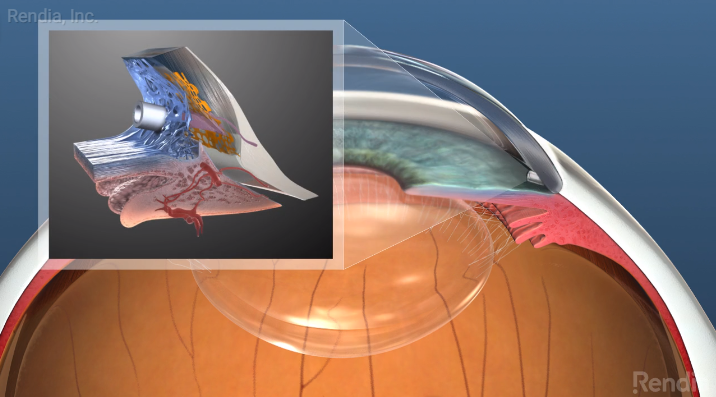 The Innovation that is MIGS