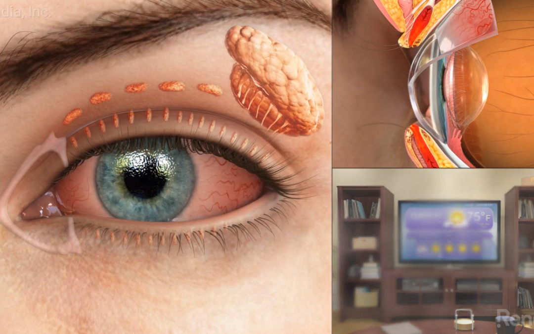 Why It’s a Prime Time to Address Dry Eye Disease