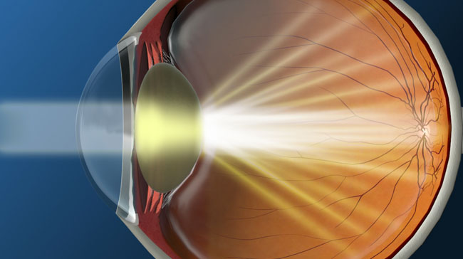 Sample Rendia Eye Care Image Showing Scattering Rays of Light