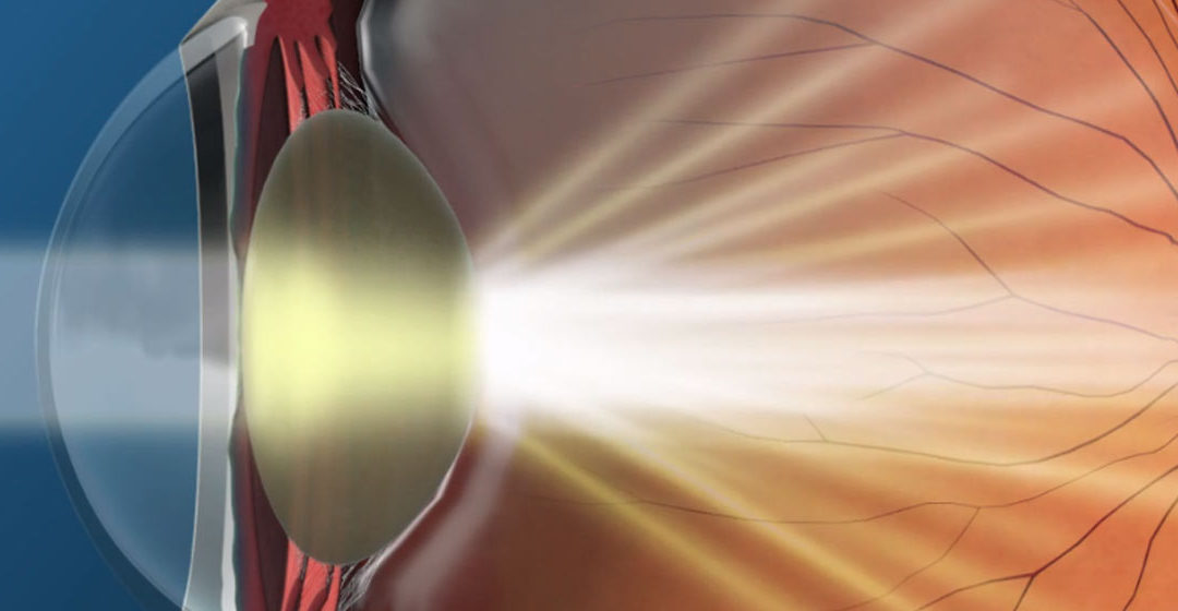 Correcting Patients’ Misconceptions About Cataracts