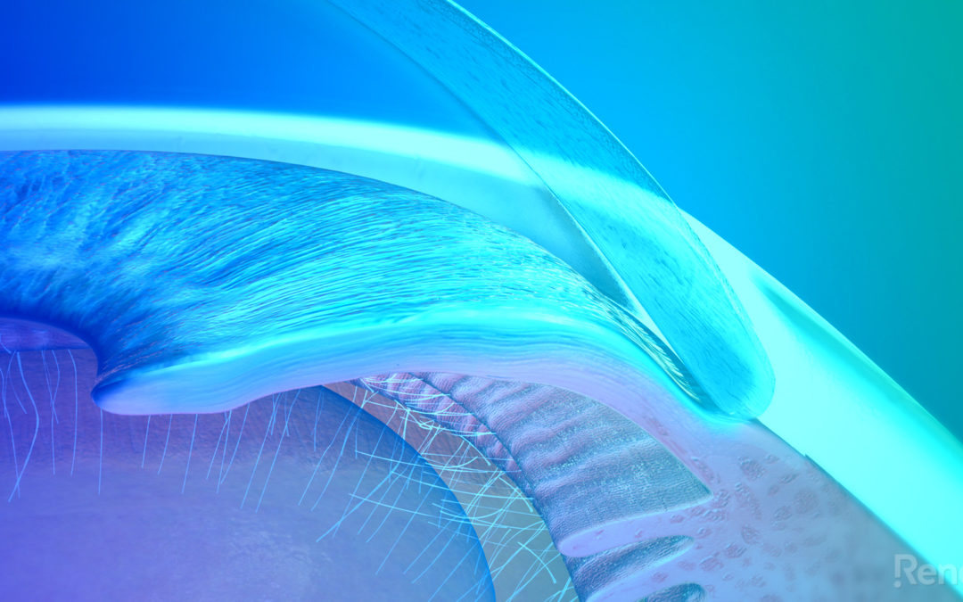 One Minute Visit – Glaucoma