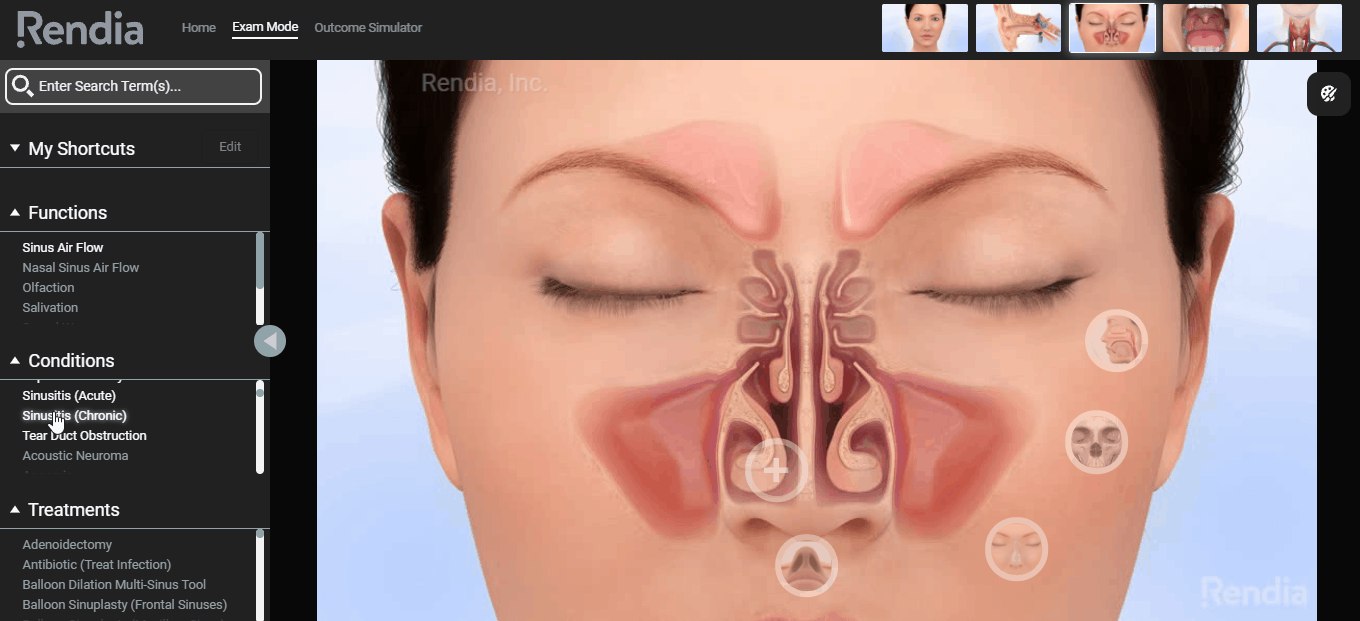 sinusitis shown on exam mode