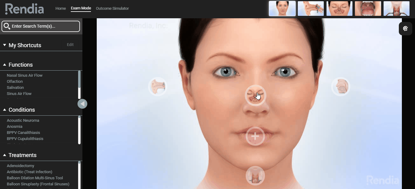 sinusitis shown on exam mode 